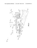 TREATMENT OF CARPAL TUNNEL SYNDROME BY INJECTION OF THE FLEXOR RETINACULUM diagram and image