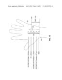 TREATMENT OF CARPAL TUNNEL SYNDROME BY INJECTION OF THE FLEXOR RETINACULUM diagram and image