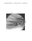 TREATMENT OF CARPAL TUNNEL SYNDROME BY INJECTION OF THE FLEXOR RETINACULUM diagram and image