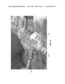 TREATMENT OF CARPAL TUNNEL SYNDROME BY INJECTION OF THE FLEXOR RETINACULUM diagram and image