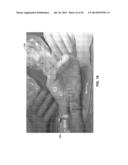 TREATMENT OF CARPAL TUNNEL SYNDROME BY INJECTION OF THE FLEXOR RETINACULUM diagram and image