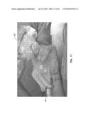 TREATMENT OF CARPAL TUNNEL SYNDROME BY INJECTION OF THE FLEXOR RETINACULUM diagram and image