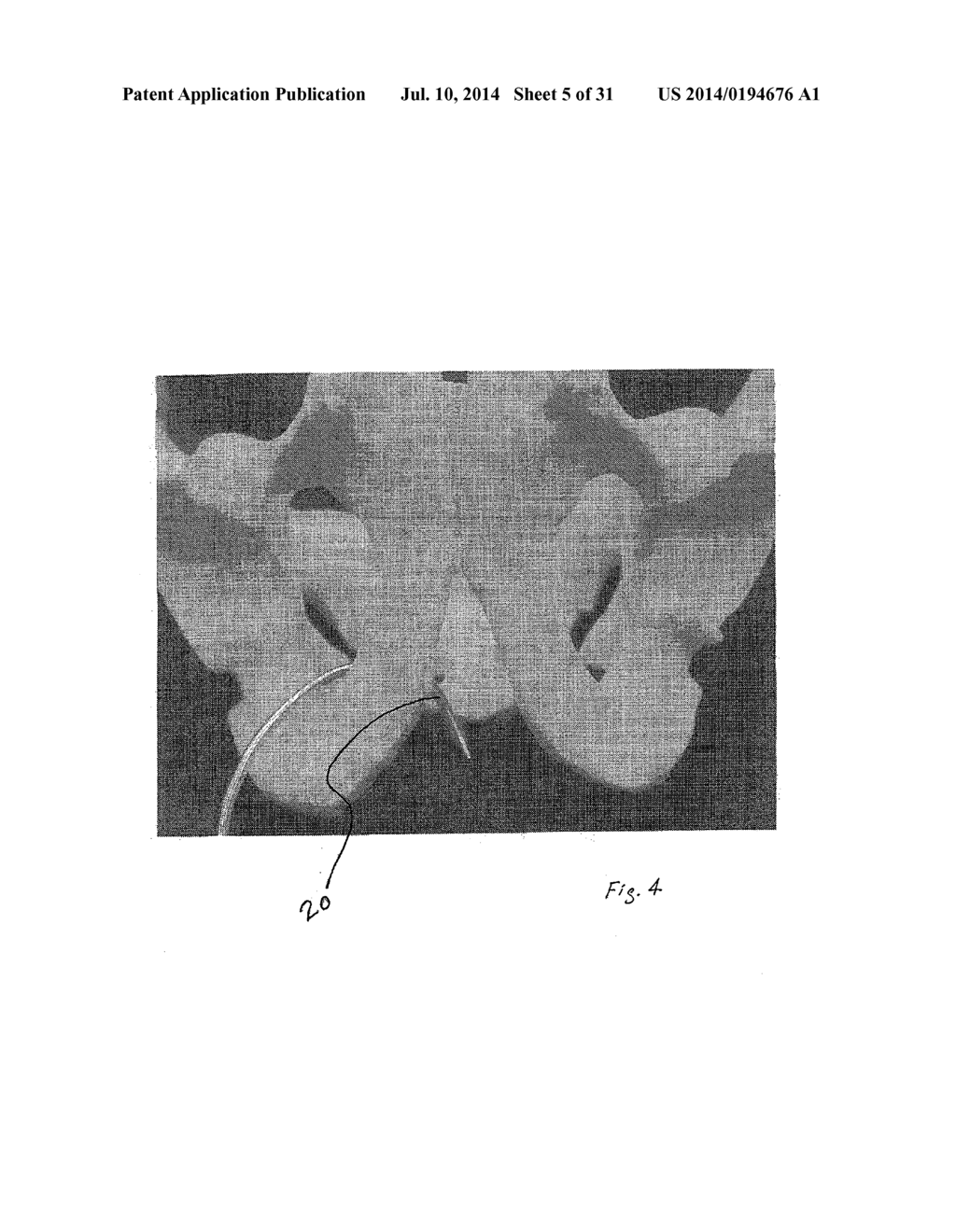 IMPLANTABLE DEVICES FOR THE TREATMENT OF INCONTINENCE AND METHODS OF USING     SAME - diagram, schematic, and image 06