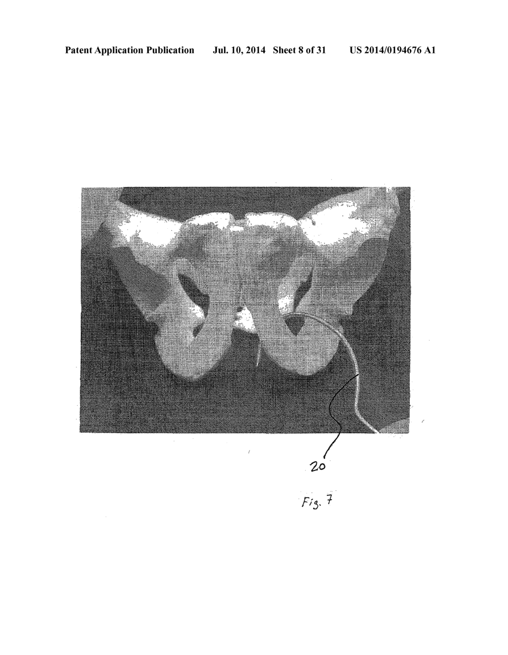 IMPLANTABLE DEVICES FOR THE TREATMENT OF INCONTINENCE AND METHODS OF USING     SAME - diagram, schematic, and image 09