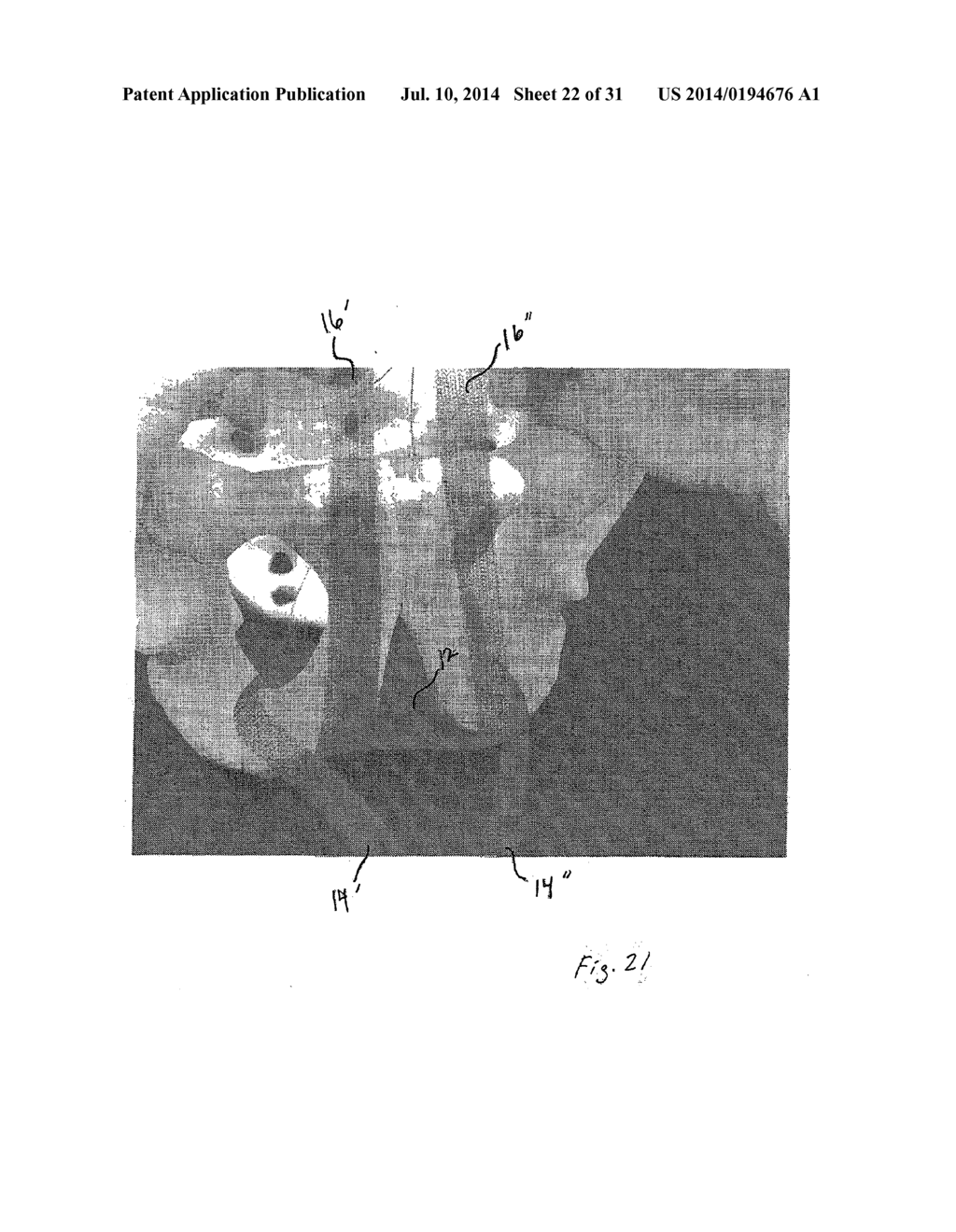 IMPLANTABLE DEVICES FOR THE TREATMENT OF INCONTINENCE AND METHODS OF USING     SAME - diagram, schematic, and image 23