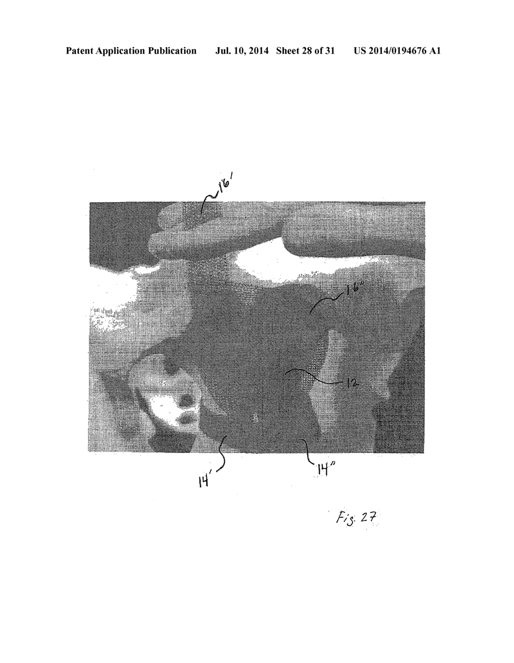 IMPLANTABLE DEVICES FOR THE TREATMENT OF INCONTINENCE AND METHODS OF USING     SAME - diagram, schematic, and image 29