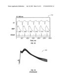 METHODS AND SYSTEMS FOR TREATING HEART INSTABILITY diagram and image