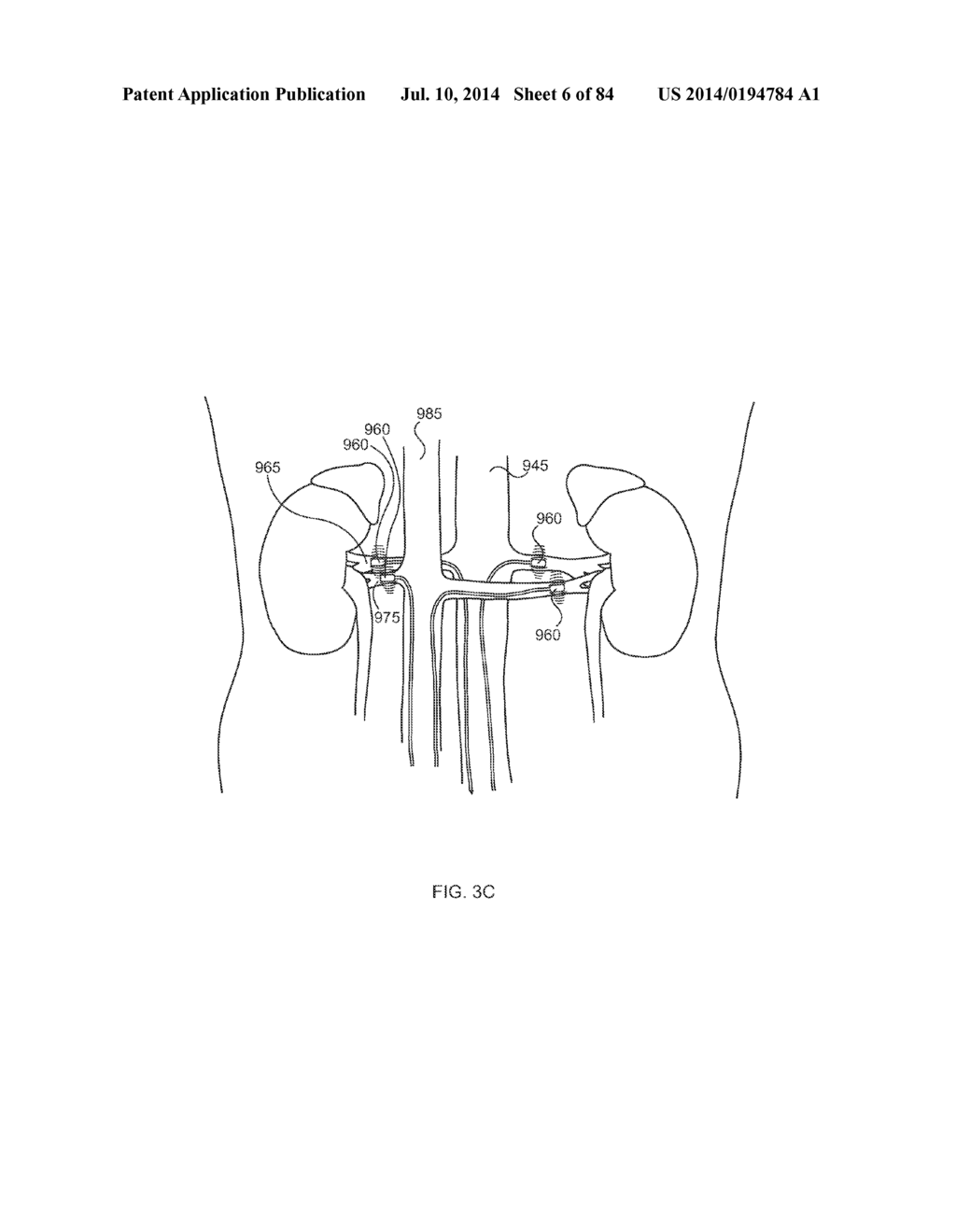 METHODS AND DEVICES FOR THERMALLY INDUCED HEPATIC NEUROMODULATION - diagram, schematic, and image 07