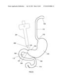 EXTERNAL ANCHORING CONFIGURATIONS FOR MODULAR GASTROINTESTINAL PROSTHESES diagram and image