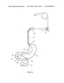 EXTERNAL ANCHORING CONFIGURATIONS FOR MODULAR GASTROINTESTINAL PROSTHESES diagram and image