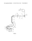 EXTERNAL ANCHORING CONFIGURATIONS FOR MODULAR GASTROINTESTINAL PROSTHESES diagram and image