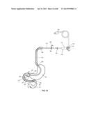 EXTERNAL ANCHORING CONFIGURATIONS FOR MODULAR GASTROINTESTINAL PROSTHESES diagram and image