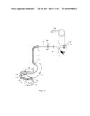 EXTERNAL ANCHORING CONFIGURATIONS FOR MODULAR GASTROINTESTINAL PROSTHESES diagram and image