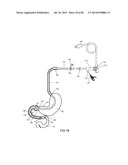 EXTERNAL ANCHORING CONFIGURATIONS FOR MODULAR GASTROINTESTINAL PROSTHESES diagram and image