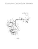 EXTERNAL ANCHORING CONFIGURATIONS FOR MODULAR GASTROINTESTINAL PROSTHESES diagram and image