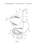 EXTERNAL ANCHORING CONFIGURATIONS FOR MODULAR GASTROINTESTINAL PROSTHESES diagram and image