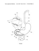 EXTERNAL ANCHORING CONFIGURATIONS FOR MODULAR GASTROINTESTINAL PROSTHESES diagram and image