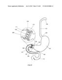 EXTERNAL ANCHORING CONFIGURATIONS FOR MODULAR GASTROINTESTINAL PROSTHESES diagram and image