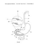 EXTERNAL ANCHORING CONFIGURATIONS FOR MODULAR GASTROINTESTINAL PROSTHESES diagram and image