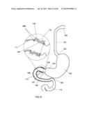 EXTERNAL ANCHORING CONFIGURATIONS FOR MODULAR GASTROINTESTINAL PROSTHESES diagram and image