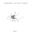 EXTERNAL ANCHORING CONFIGURATIONS FOR MODULAR GASTROINTESTINAL PROSTHESES diagram and image