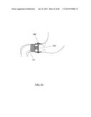 EXTERNAL ANCHORING CONFIGURATIONS FOR MODULAR GASTROINTESTINAL PROSTHESES diagram and image