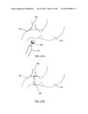 EXTERNAL ANCHORING CONFIGURATIONS FOR MODULAR GASTROINTESTINAL PROSTHESES diagram and image