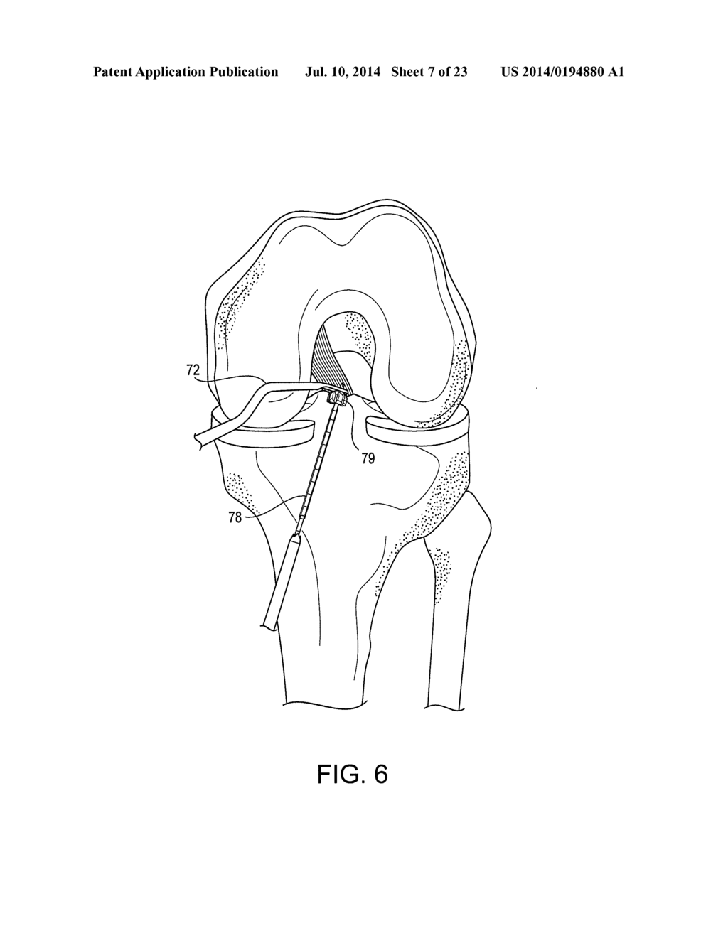 SYSTEM FOR ACL RECONSTRUCTION USING RETROGRADE CUTTER - diagram, schematic, and image 08