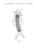 SYSTEMS AND METHODS FOR ATTACHING A PROSTHESIS WITHIN A BODY LUMEN OR     HOLLOW ORGAN diagram and image