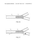 CONNECTION OF AN ENDOVASCULAR INTERVENTION DEVICE TO A MANIPULATION MEMBER diagram and image