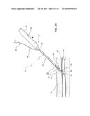 VASCULAR CLOSURE DEVICE WITH IMPROVED SIDE LOADING diagram and image