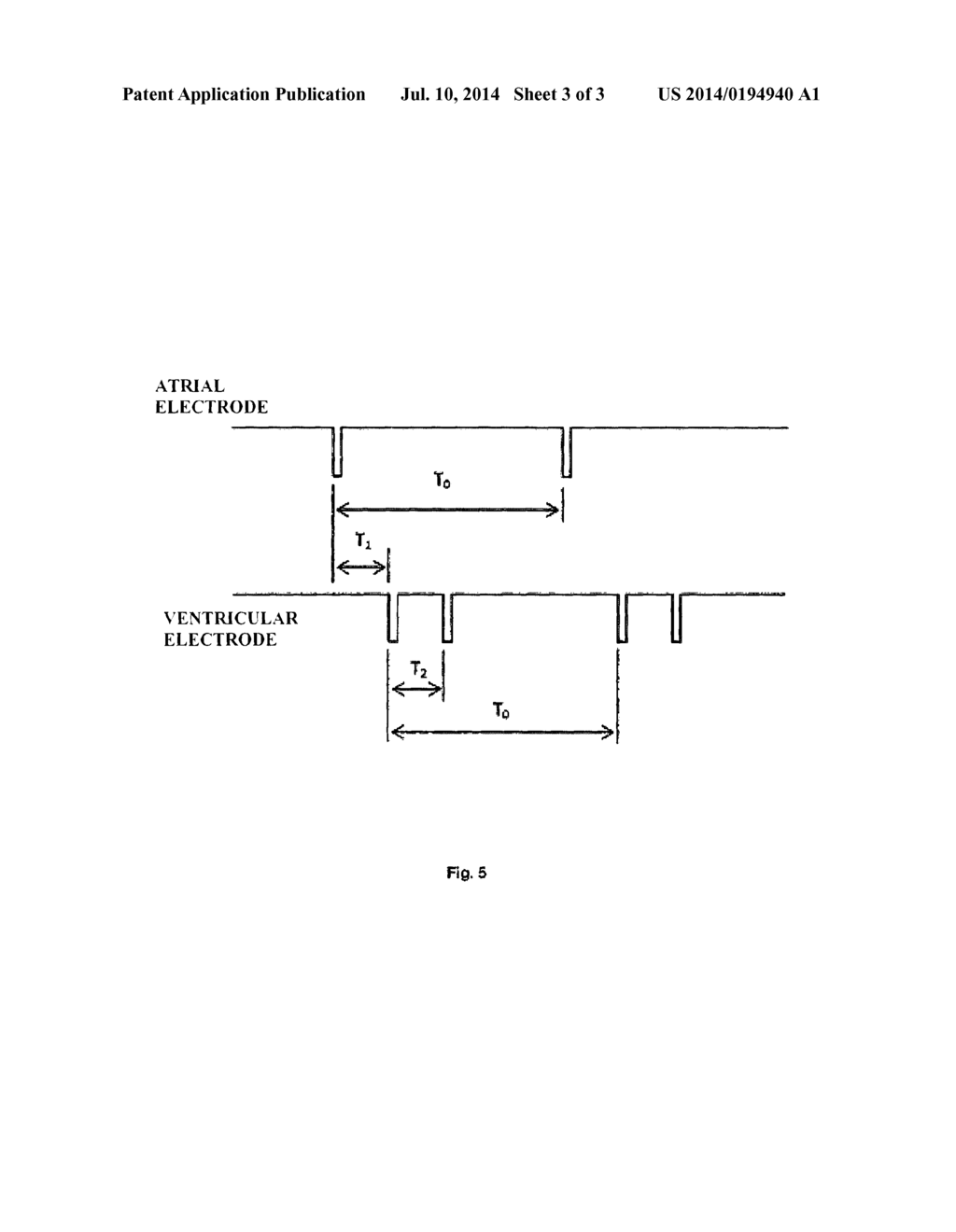 HEART STIMULATION DEVICE AND RESPECTIVE CONTROL SYSTEM - diagram, schematic, and image 04