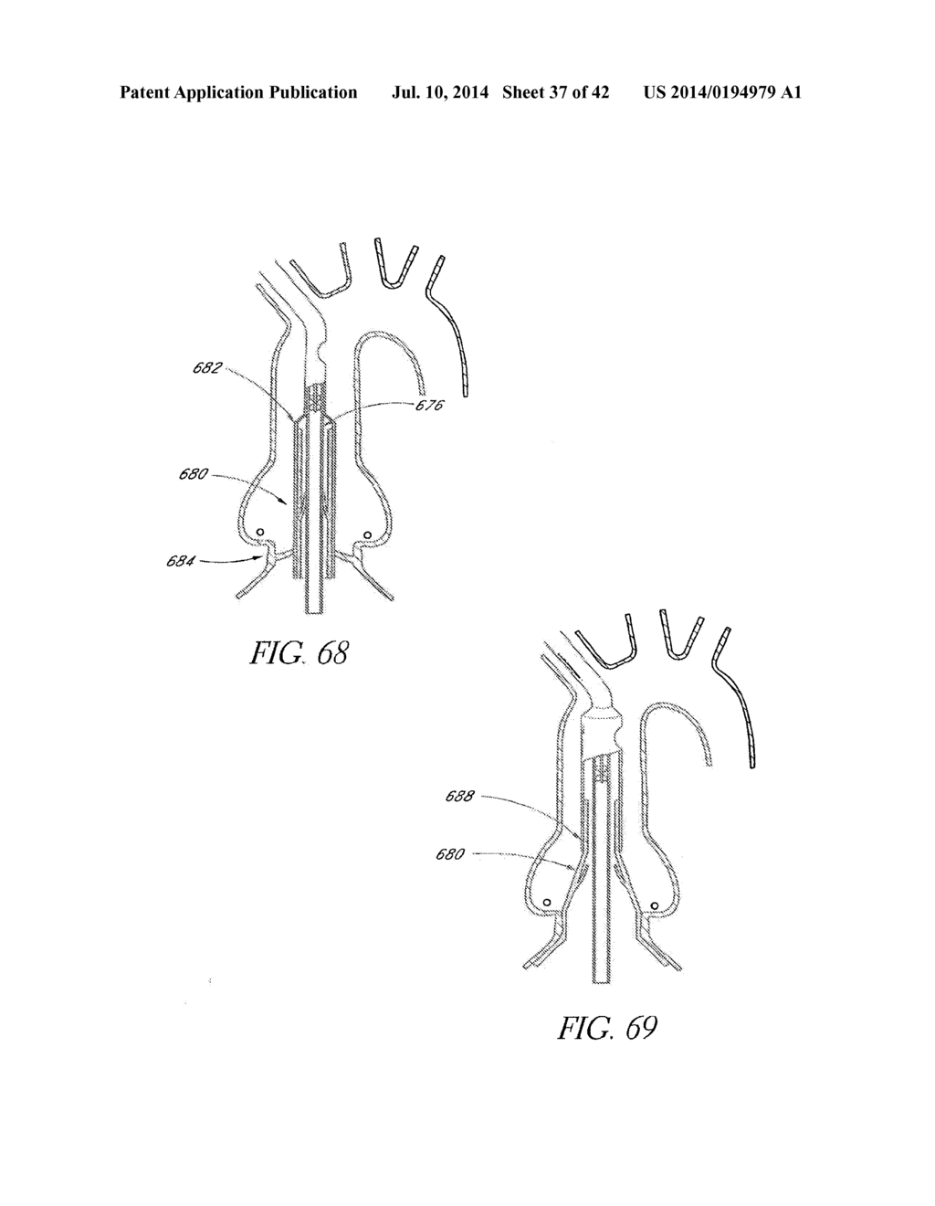 Transcatheter Heart Valves - diagram, schematic, and image 38