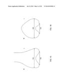 PATIENT-ADAPTED AND IMPROVED ARTICULAR IMPLANTS, DESIGNS AND RELATED GUIDE     TOOLS diagram and image