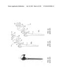 PATIENT-ADAPTED AND IMPROVED ARTICULAR IMPLANTS, DESIGNS AND RELATED GUIDE     TOOLS diagram and image