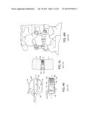 PATIENT-ADAPTED AND IMPROVED ARTICULAR IMPLANTS, DESIGNS AND RELATED GUIDE     TOOLS diagram and image