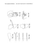 PATIENT-ADAPTED AND IMPROVED ARTICULAR IMPLANTS, DESIGNS AND RELATED GUIDE     TOOLS diagram and image