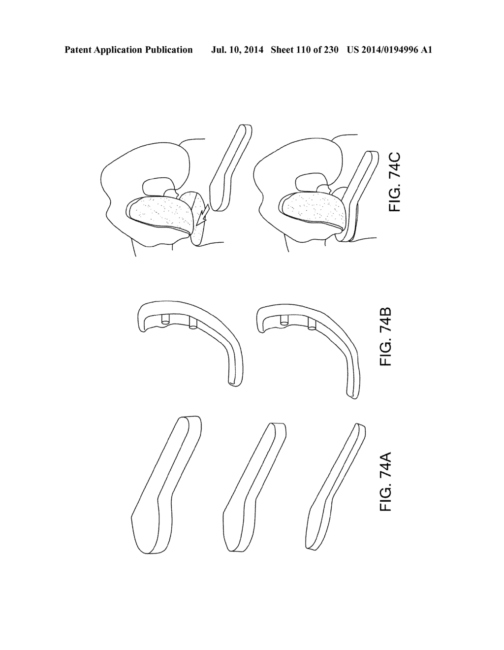 PATIENT-ADAPTED AND IMPROVED ARTICULAR IMPLANTS, DESIGNS AND RELATED GUIDE     TOOLS - diagram, schematic, and image 112
