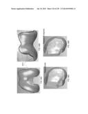 PATIENT-ADAPTED AND IMPROVED ARTICULAR IMPLANTS, DESIGNS AND RELATED GUIDE     TOOLS diagram and image