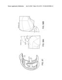 PATIENT-ADAPTED AND IMPROVED ARTICULAR IMPLANTS, DESIGNS AND RELATED GUIDE     TOOLS diagram and image