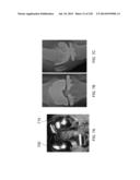 PATIENT-ADAPTED AND IMPROVED ARTICULAR IMPLANTS, DESIGNS AND RELATED GUIDE     TOOLS diagram and image