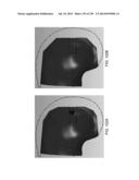 PATIENT-ADAPTED AND IMPROVED ARTICULAR IMPLANTS, DESIGNS AND RELATED GUIDE     TOOLS diagram and image