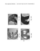 PATIENT-ADAPTED AND IMPROVED ARTICULAR IMPLANTS, DESIGNS AND RELATED GUIDE     TOOLS diagram and image