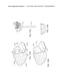 PATIENT-ADAPTED AND IMPROVED ARTICULAR IMPLANTS, DESIGNS AND RELATED GUIDE     TOOLS diagram and image