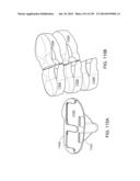 PATIENT-ADAPTED AND IMPROVED ARTICULAR IMPLANTS, DESIGNS AND RELATED GUIDE     TOOLS diagram and image