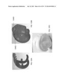 PATIENT-ADAPTED AND IMPROVED ARTICULAR IMPLANTS, DESIGNS AND RELATED GUIDE     TOOLS diagram and image