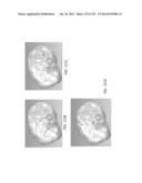 PATIENT-ADAPTED AND IMPROVED ARTICULAR IMPLANTS, DESIGNS AND RELATED GUIDE     TOOLS diagram and image