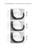 PATIENT-ADAPTED AND IMPROVED ARTICULAR IMPLANTS, DESIGNS AND RELATED GUIDE     TOOLS diagram and image