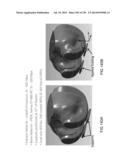 PATIENT-ADAPTED AND IMPROVED ARTICULAR IMPLANTS, DESIGNS AND RELATED GUIDE     TOOLS diagram and image