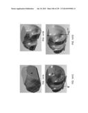 PATIENT-ADAPTED AND IMPROVED ARTICULAR IMPLANTS, DESIGNS AND RELATED GUIDE     TOOLS diagram and image